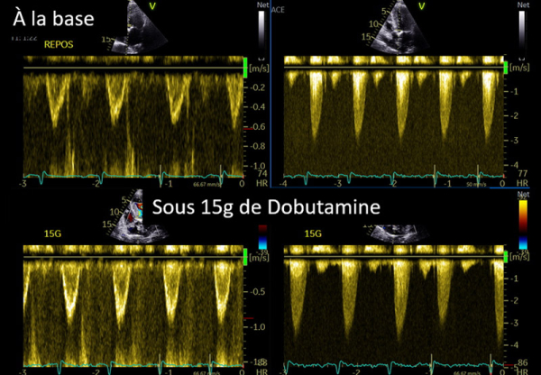 Echo Dobu de viabilité, à la recherche d’une pseudo-sténose