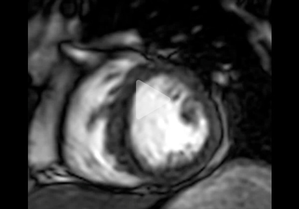 Vidéo 5 du cas clinique "Une amylose pas comme les autres"