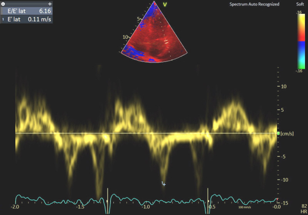 Image 4 : échocardiographie Doppler tissulaire à l’anneau mitral latéral