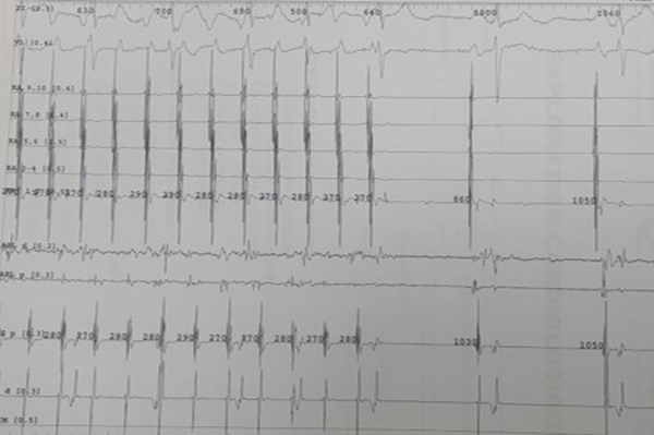 une-arythmie-figure5