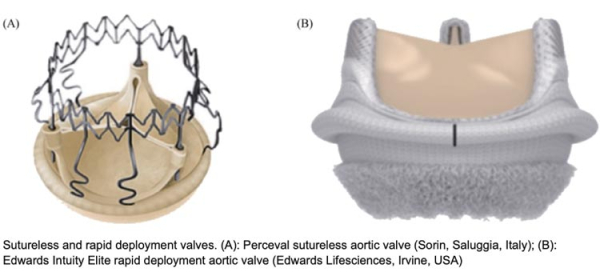 Sutureless and rapid deployment valves