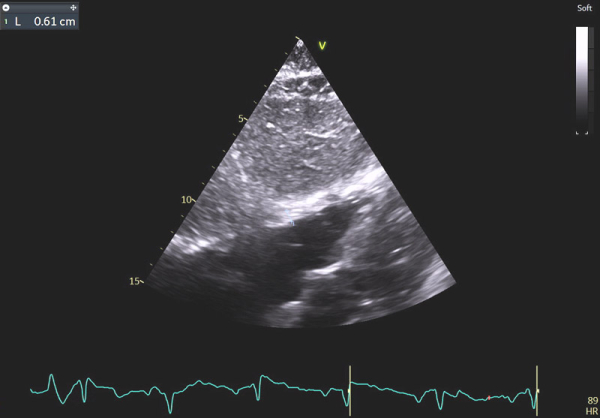 Image 9 : échocardiographie 2D en incidence sous-costale, mesure de l’épaisseur de la paroi du ventricule droit (VD)
