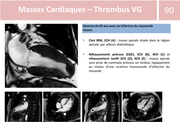 Fiche de synthèse : Infarctus du myocarde avec thrombus intra-VG