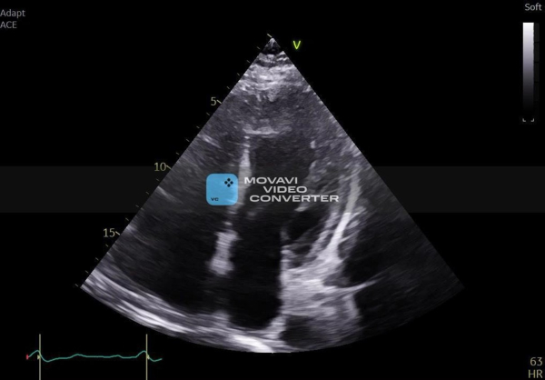 une-CMH-toujours-symptomatique-figure11