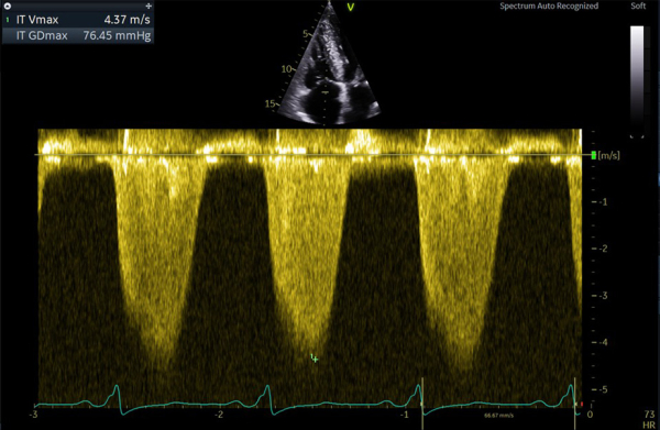 Estimation des PAPs sur le flux d’IT en doppler couleur