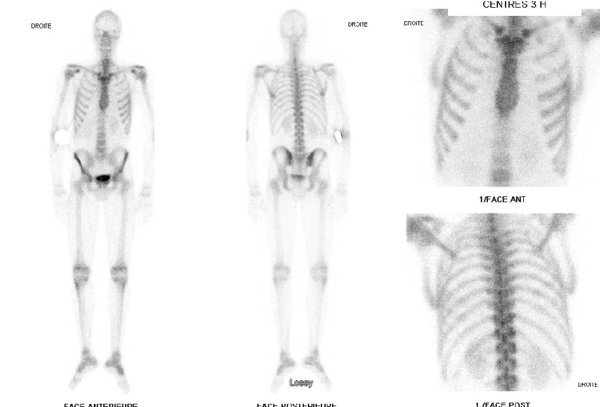 Le syndrome du Caméléon - Scintigraphie au diphosphonate: négative