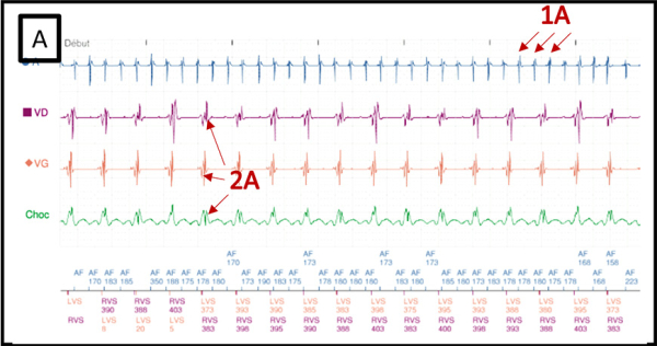 amylose-et-arythmie-figure4