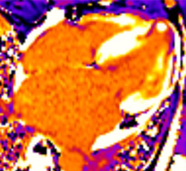 Figure 7 : T1 post-contraste diminué à l’apex (nécrose)