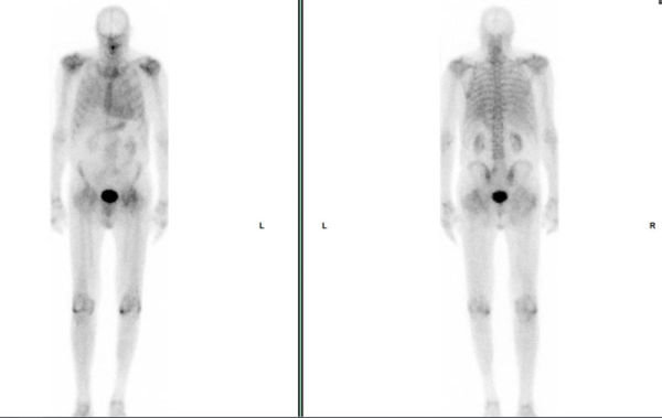 Scintigraphie osseuse à la recherche d’amylose cardiaque 
