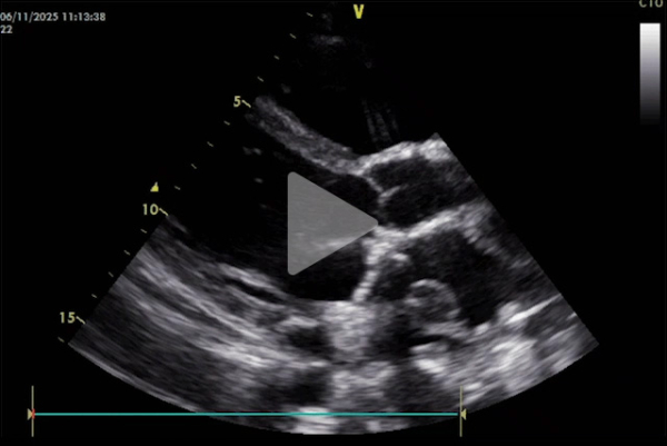 Complication-rare-d-un-remplacement-valvulaire-mitrale-video3-img.jpg