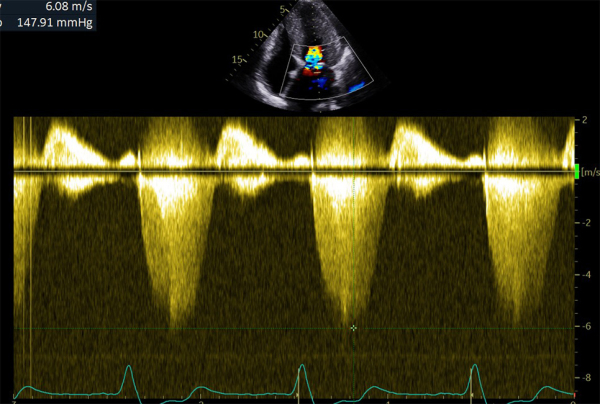 Flux doppler continu trans-mitrale d’IM