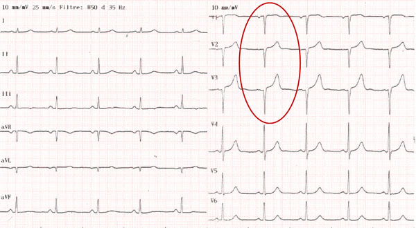 Image 2 du cas clinique "Une amylose pas comme les autres" - Electrocardiogramme