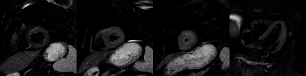 Séquences STIR au en petit axe basal, médian, et apical, et en apical 4 cavités