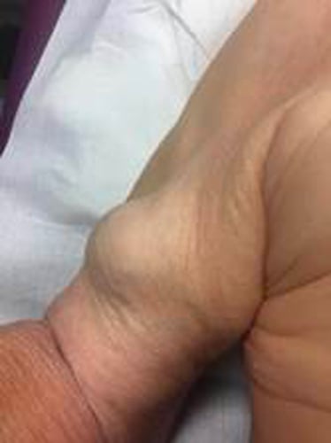 Les atteintes extra-cardiaques