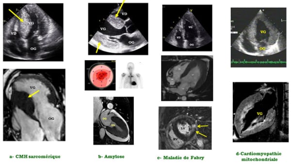 Figure 3 : Différentes formes de cardiomyopathies hypertrophiques, et rôle de l’imagerie