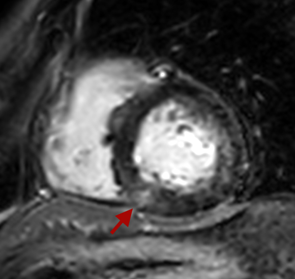 Figure 1 : Séquence de rehaussement tardif en coupe petit axe mettant en évidence un défaut de clairance du gadolinium en regard du point d’insertion de la paroi inférieure du ventricule droit (flèche rouge).