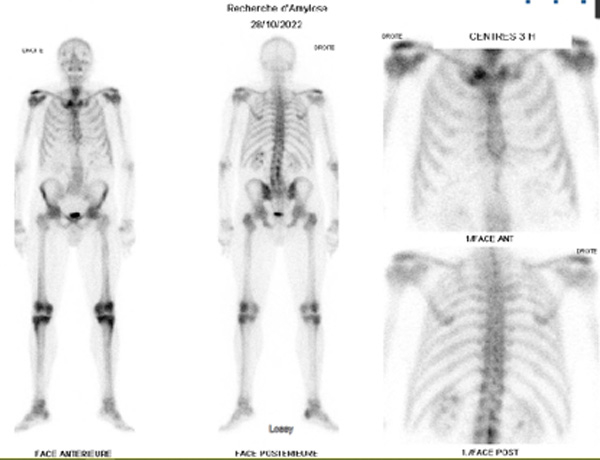 Figure 4 : Scintigraphie osseuse