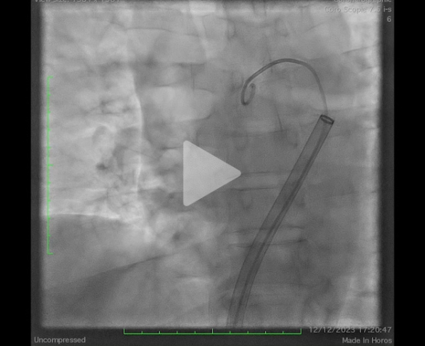 un-infarctus-mais-pas-du-myocarde-vidéo2-img