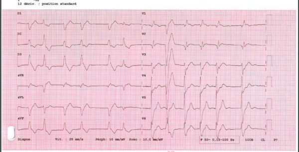 Électrocardiogramme d'entrée
