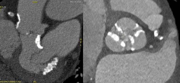 Calcifications