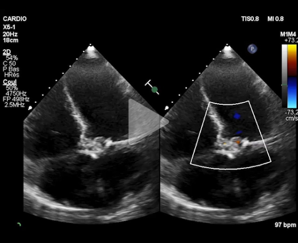 TAVI-dans-l-endocardite-aortique-destructrice-video3-img.jpg