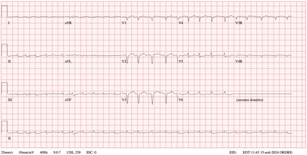 Electrocardiogramme