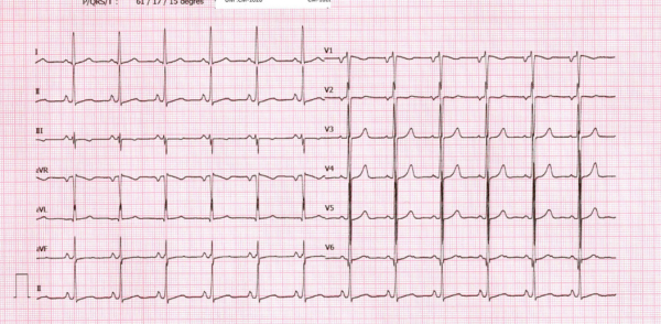 Examens du patient - ECG
