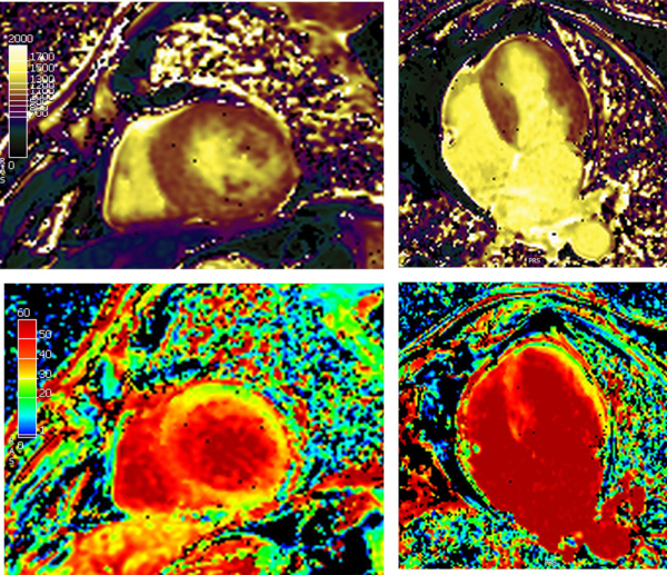 IRM cœur - évocatrice d'une amylose cardiaque