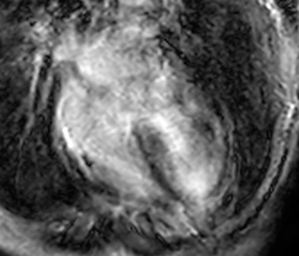 Image 11 du cas clinique "Une amylose pas comme les autres" - IRM myocardique