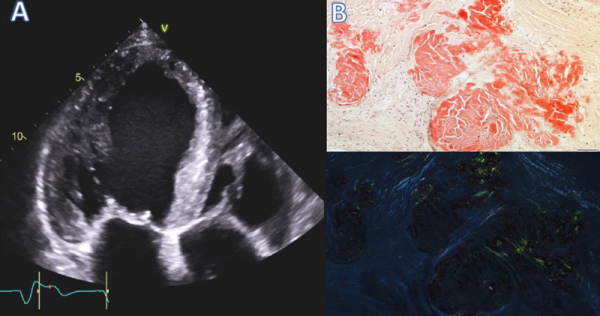 Figure 1: A. 4 cavités montant la dilatation du ventricule gauche et l’épaississement des feuillets valulaire mitraux. B. Présences de dépôts rouge Congo positifs épars dans la valve mitrale avec birefringence jaune-vert en lumière polarisée confirmant le diagnostic d’amylose