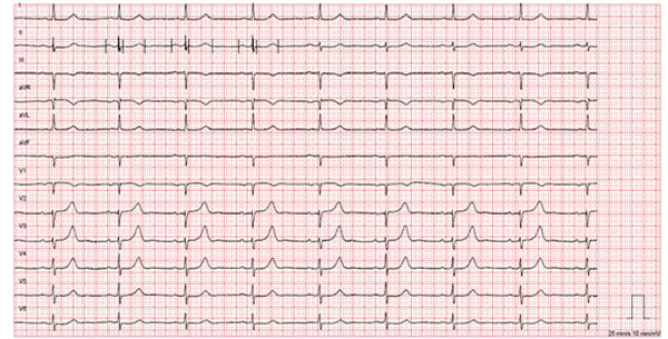 ECG patiente de 72 ans qui consulte pour un dyspnée d'effort et une fatigue générale évoluant depuis 3 mois environs