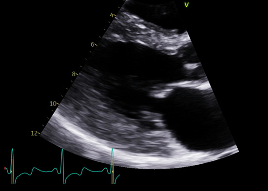 Figure 1 : Hypertrophie ventriculaire gauche concentrique modérée (13.5 mm en latéral) en échocardiographie en cas de maladie de Fabry chez une femme âgée de 40 ans