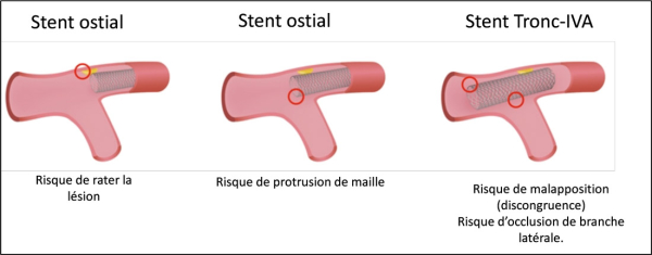 Schéma représentant les risques associés aux 2 stratégies d’angioplastie