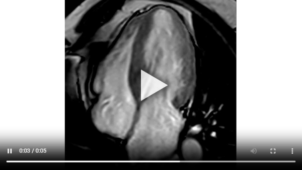 Vidéo 2 : Ciné-IRM montrant un flux d’obstruction sous-aortique en regard d’une zone d’hypertrophie septale associée à une régurgitation mitrale