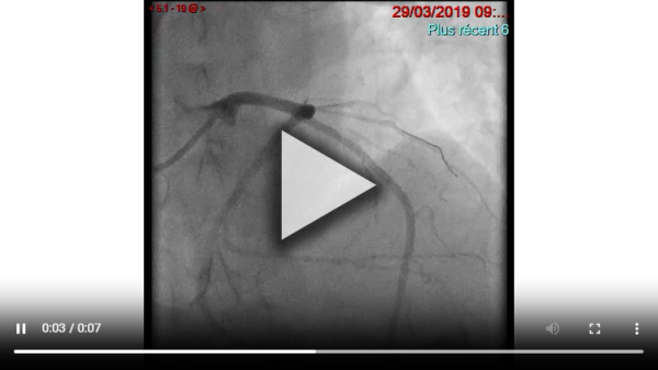 Angiographie pré alcoolisation