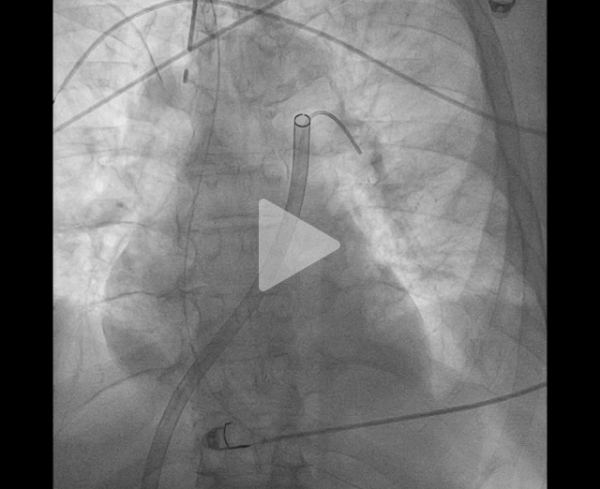 un-infarctus-mais-pas-du-myocarde-vidéo5-img