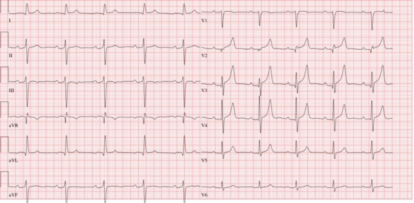 Exploration électrophysiologique: intervalle HV normal; implantation Holter sous-cutanée