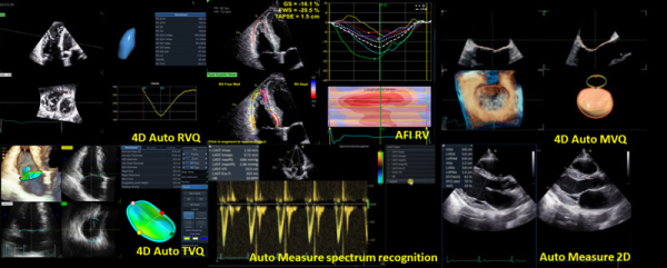 Figure 3. Exemple d’outils de quantification automatique disponibles chez GE Healthcare.