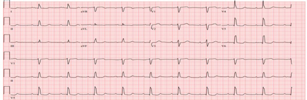 ECG de contrôle post cardioversion 