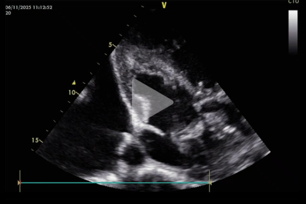 Complication-rare-d-un-remplacement-valvulaire-mitrale-video9-img.jpg