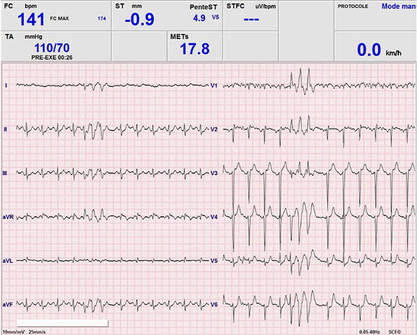 Image 2 du cas clinique "Une amylose AL précoce"