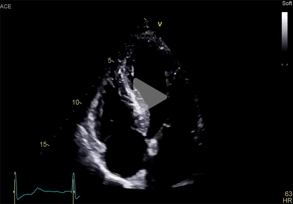 Vidéo 3 du cas clinique "Une amylose pas comme les autres"