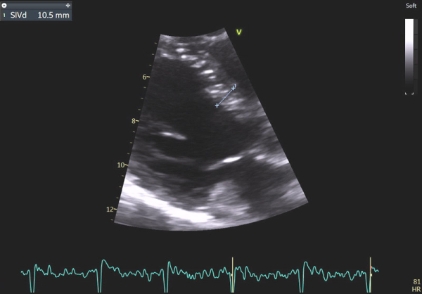 Image 2 : échocardiographie 2D en incidence parasternale grand-axe : mesure du septum inter-ventriculaire
