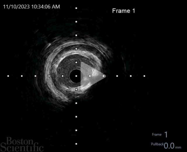 Run IVUS pré angioplastie