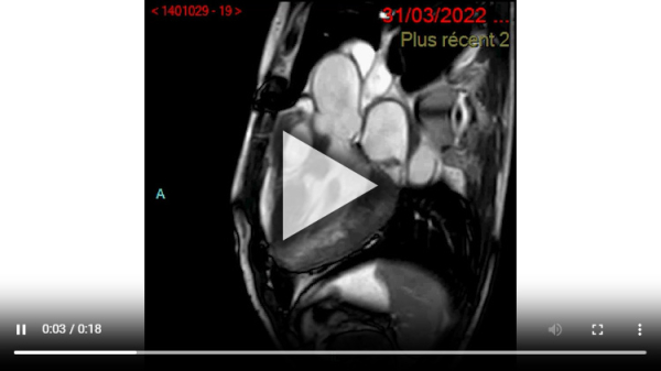 IRM: ciné LVOT