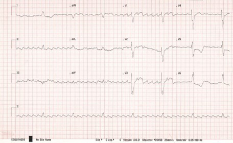 une-arythmie-figure3