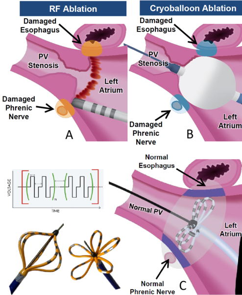 Figure 1 : A) Ablation de fibrillation atriale par RF. B)  Ablation de fibrillation atriale par cryoablation C) Ablation de fibrillation atriale par électroporation