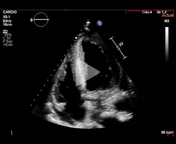 Syndrome_oedémateux_video3_img