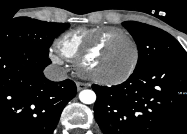 Le syndrome du Caméléon - Scanner Cardiaque 2