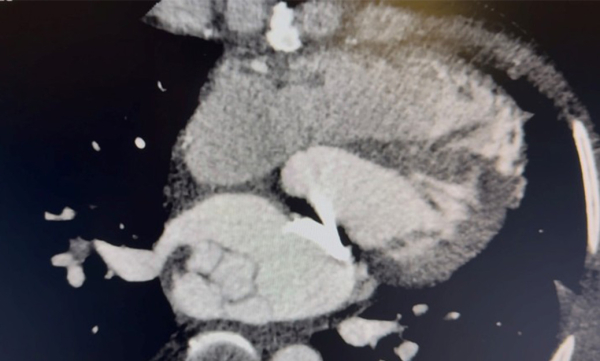 Complication-rare-d-un-remplacement-valvulaire-mitrale-figure3.jpg